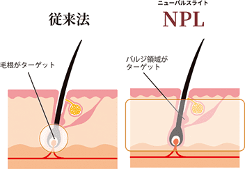 NPL脱毛はバルジ領域に直接働きかけます